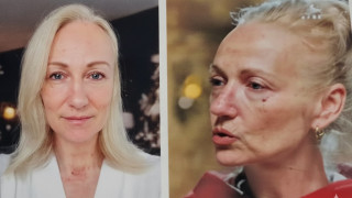 Край на повехналата кожа: Невена Бозукова изглади лицето си