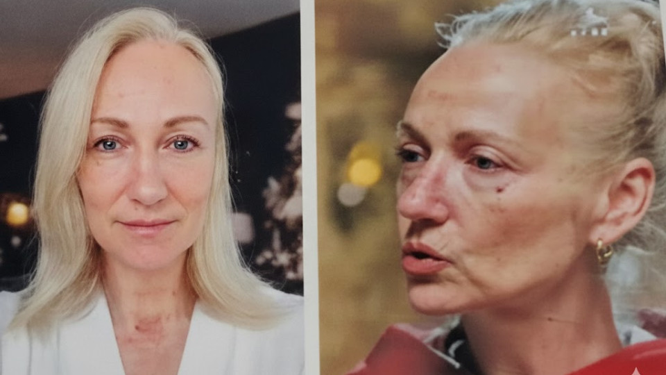 Край на повехналата кожа: Невена Бозукова изглади лицето си